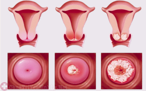 Phụ nữ mắc bệnh viêm cổ tử cung cũng khiến nam giới bị yếu sinh lý nhưng tinh trùng tốt vẫn không thể sinh con